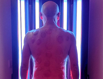 Fototerapia e infrarossi